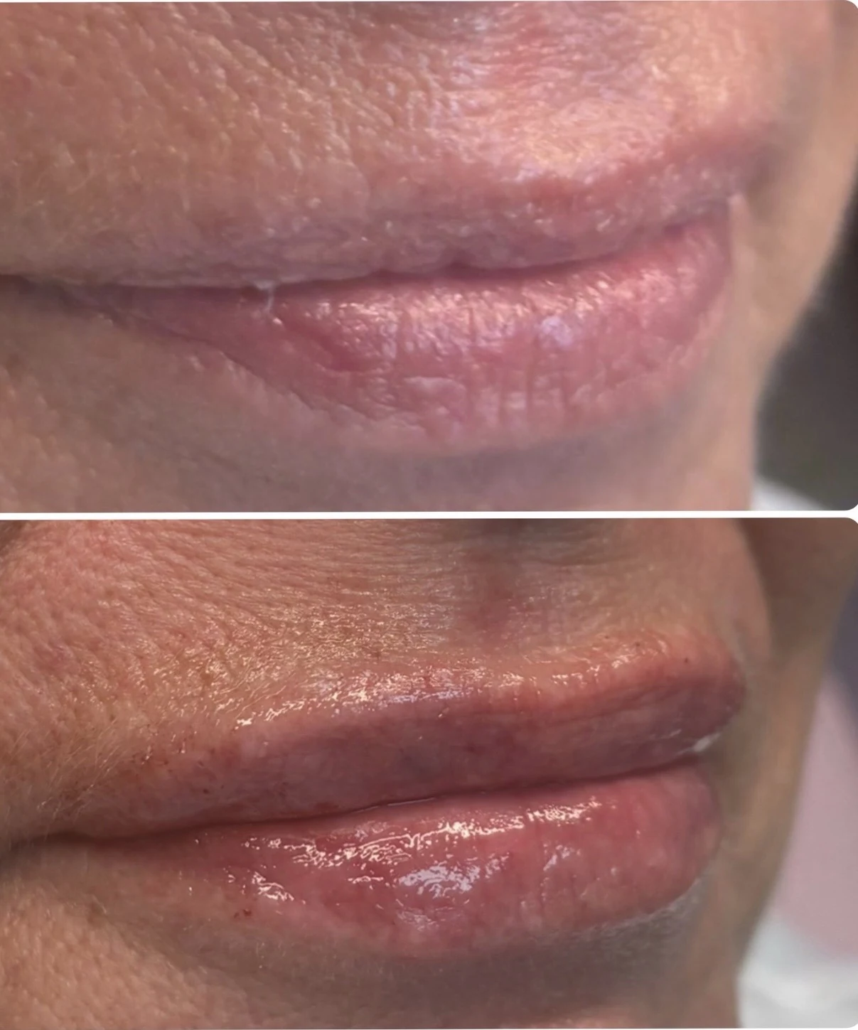 Before and after lip filler comparison showing refreshed lip hydration and structure