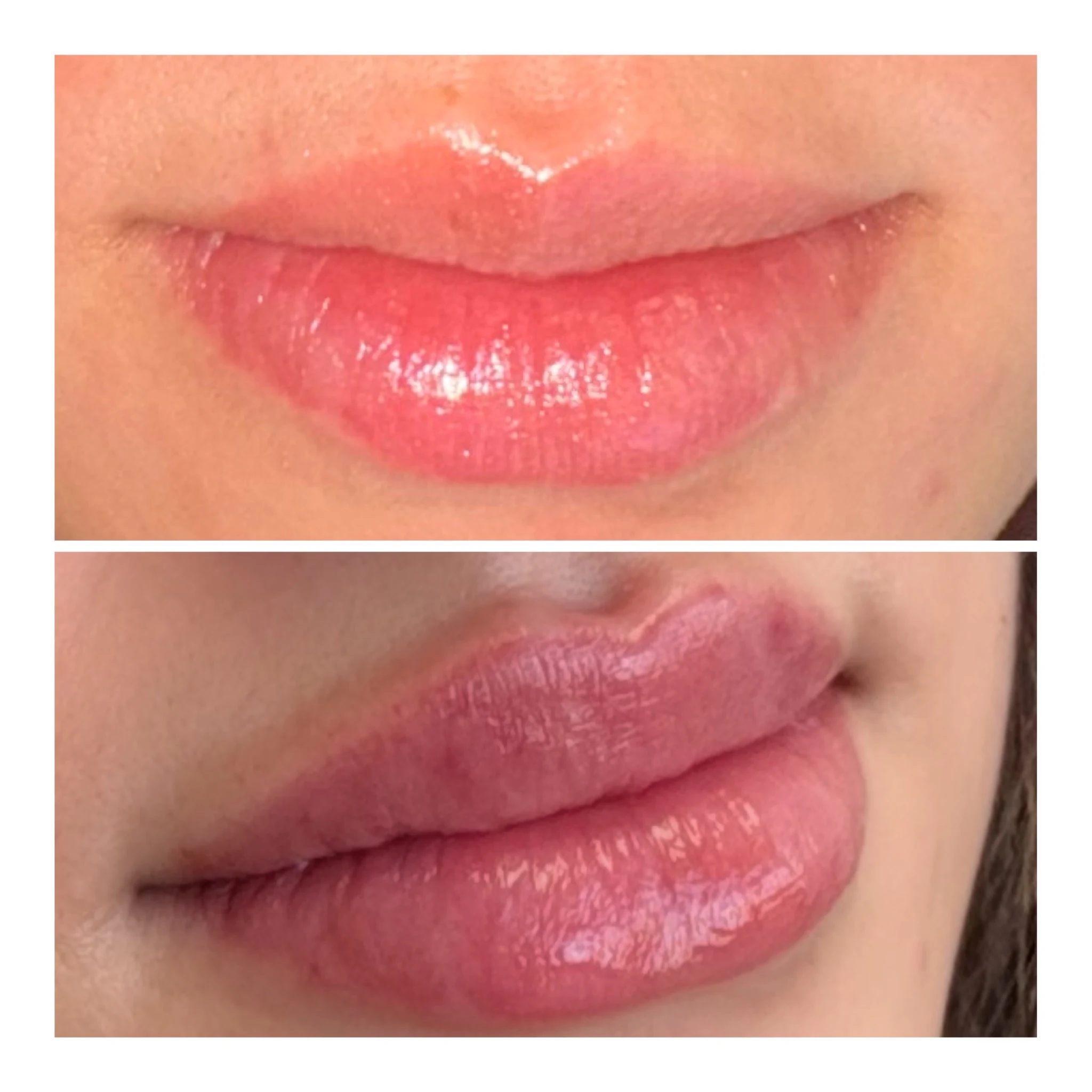Before and after lip filler comparison showing softly built shape and hydration