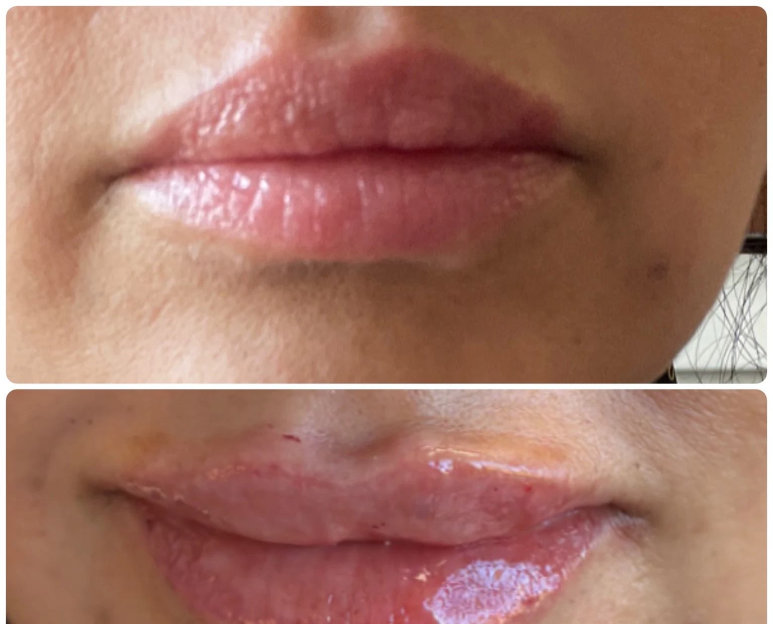 Before and after lip filler comparison showing a gentle lip refresh
