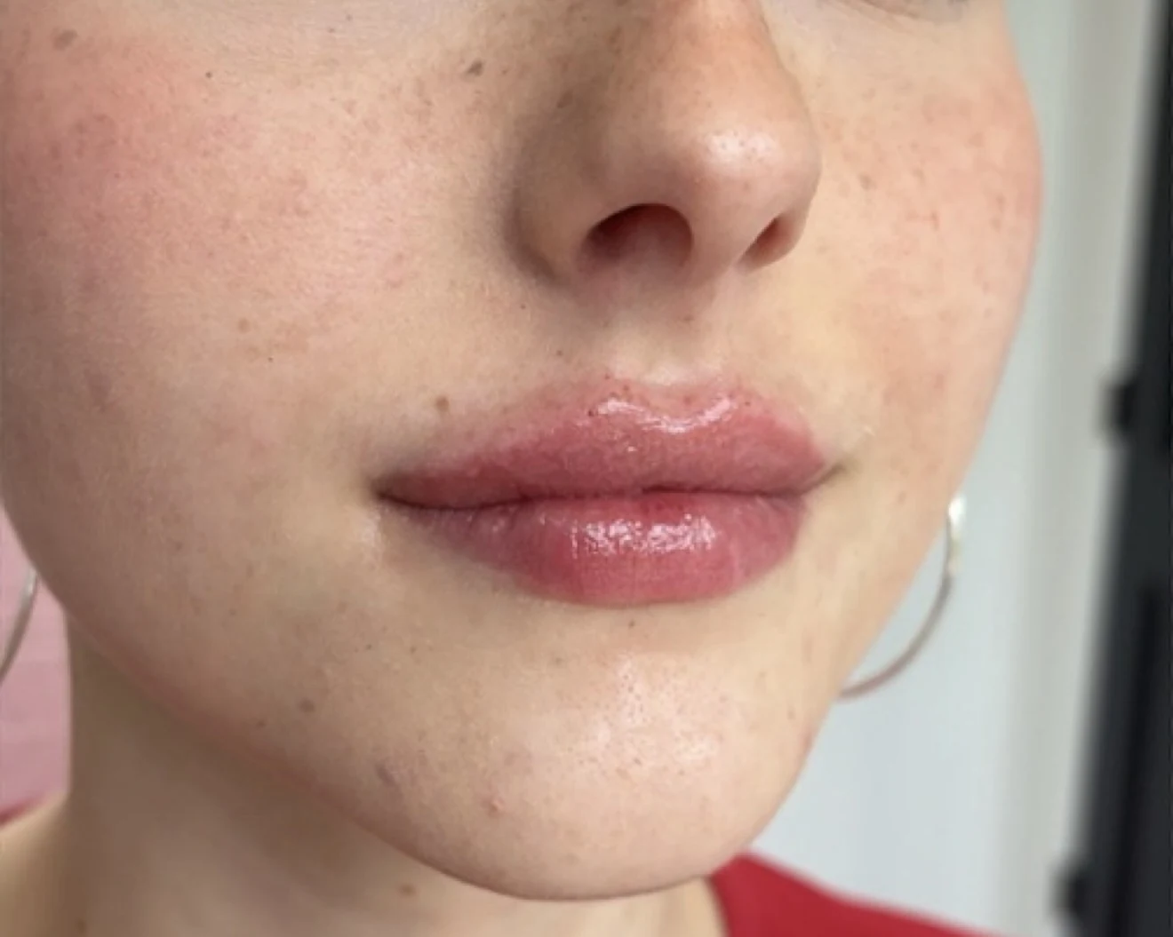 Subtle three-quarter view of a natural lip filler result