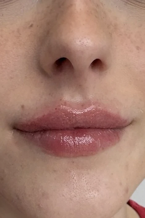 Natural front view of subtle lip filler refinement