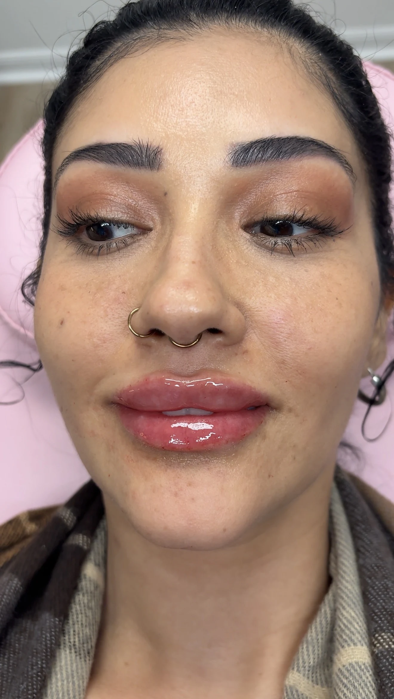 Full-face view showing balanced natural lip filler results