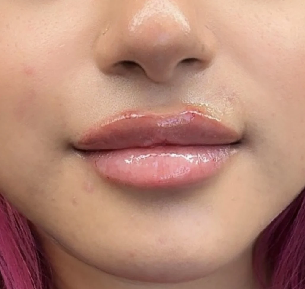 Balanced front view of a softly enhanced lip filler result