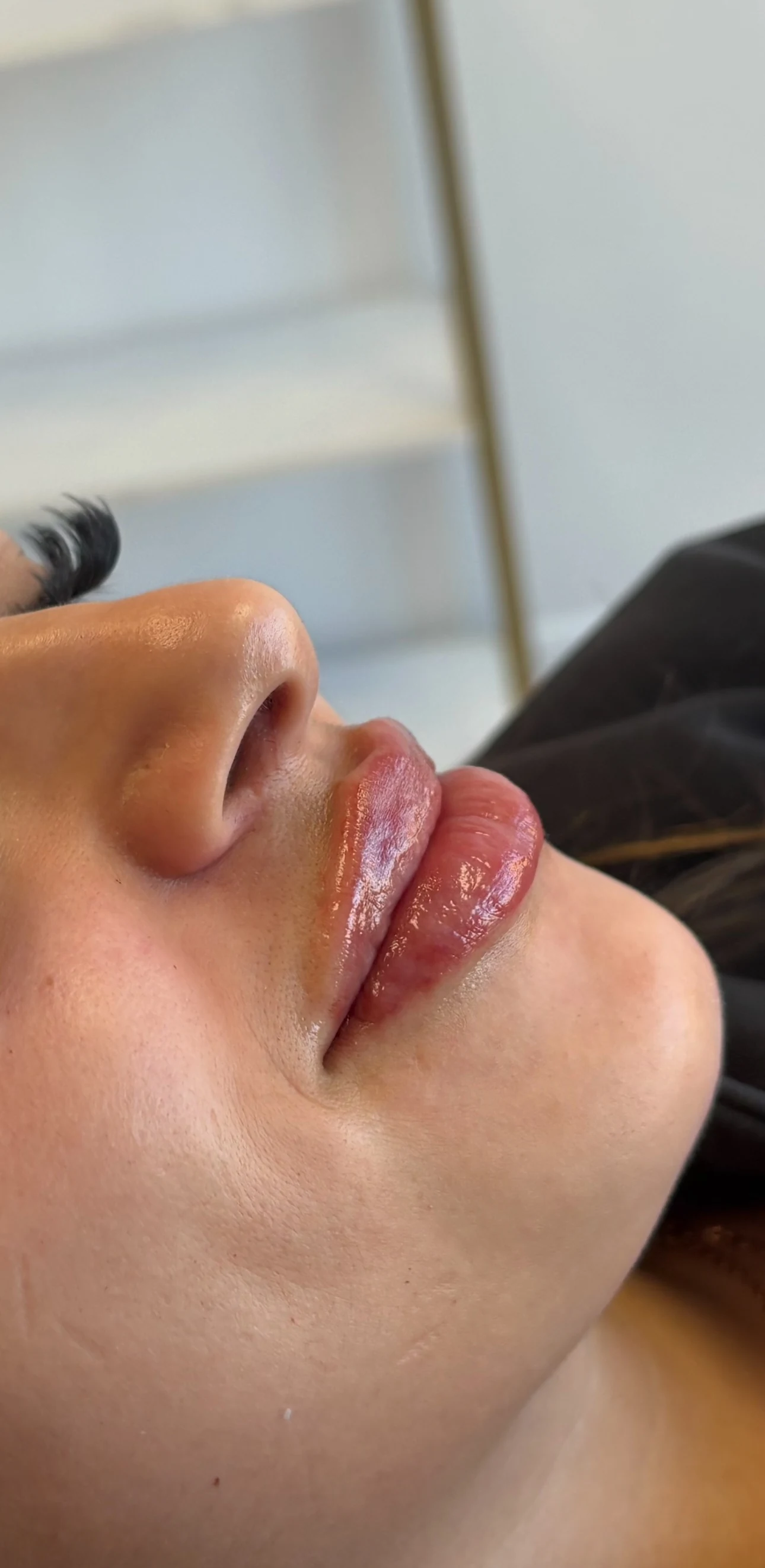 Angled profile showing shape and projection after lip filler